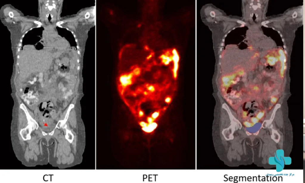 پت اسکن چیست و چه چیزی نشان میدهد؟ | عکس سالم، تفسیر و عوارض