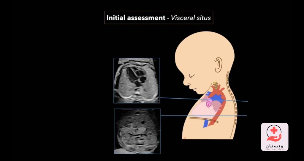 اکو قلب جنین