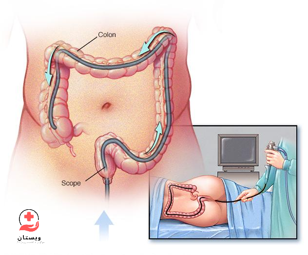 اینفوگرافیکی از کولونوسکوپی