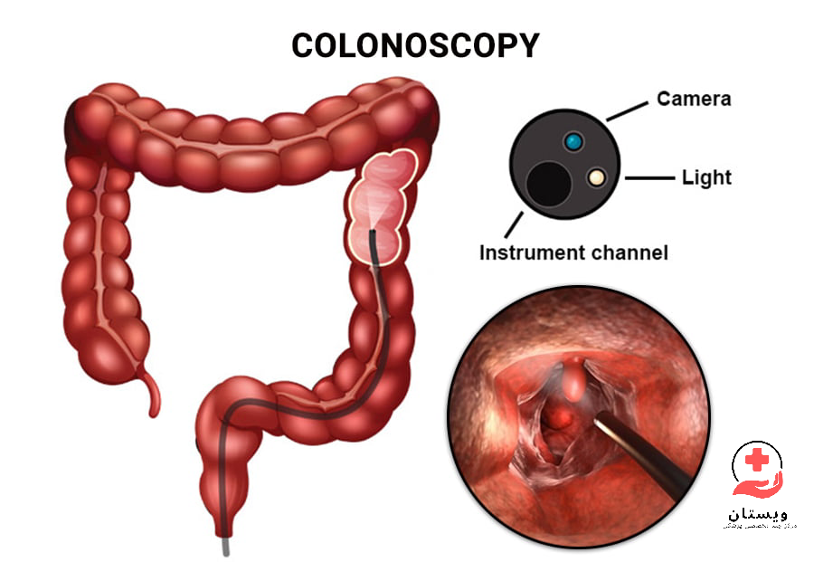 نمای اینفوگرافیکی از کولونوسکوپی روده