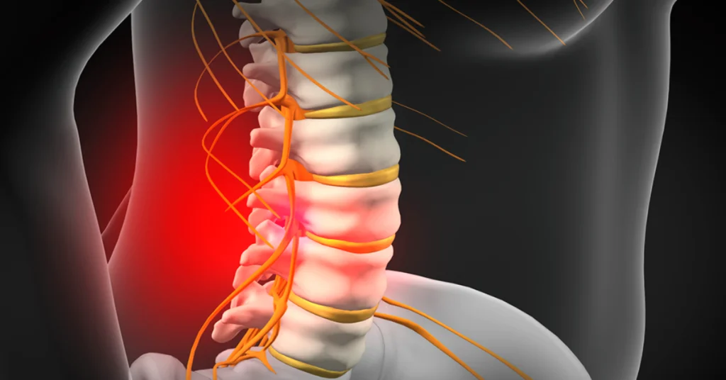 تصویر اینفوگرافیکی از دیسک کمر