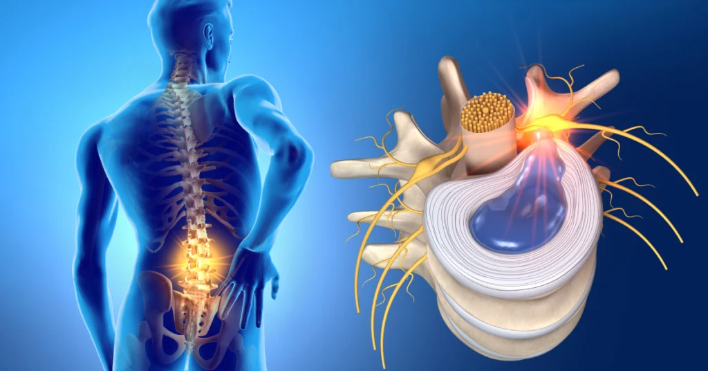 علائم دیسک کمر چیست؟ | بررسی علائم خفیف، خطرناک و تأثیر آن بر پاها