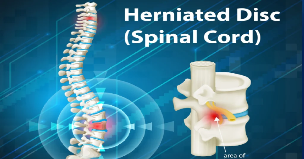 نمای اینفوگرافیکی از دیسک کمر