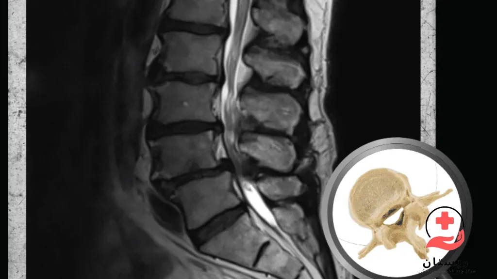 همه چیز درباره ام آر آی کمر و لگن | نحوه انجام + هزینه و نکات مهم|ام آر آی کمر