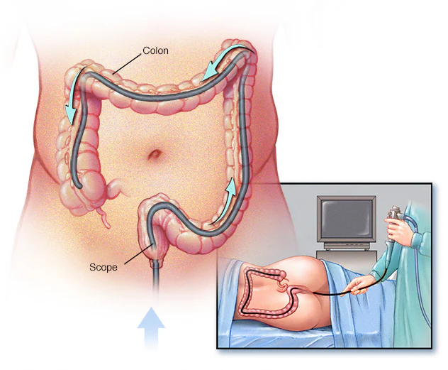 همه چیز درباره آمادگی کولونوسکوپی و مراقبتهای بعد از آن