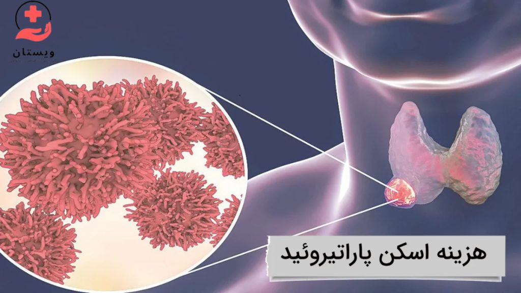 parathyroid-scan هزینه اسکن پاراتیروئید تصویری از محل قرار گیری غده پاراتیروئید