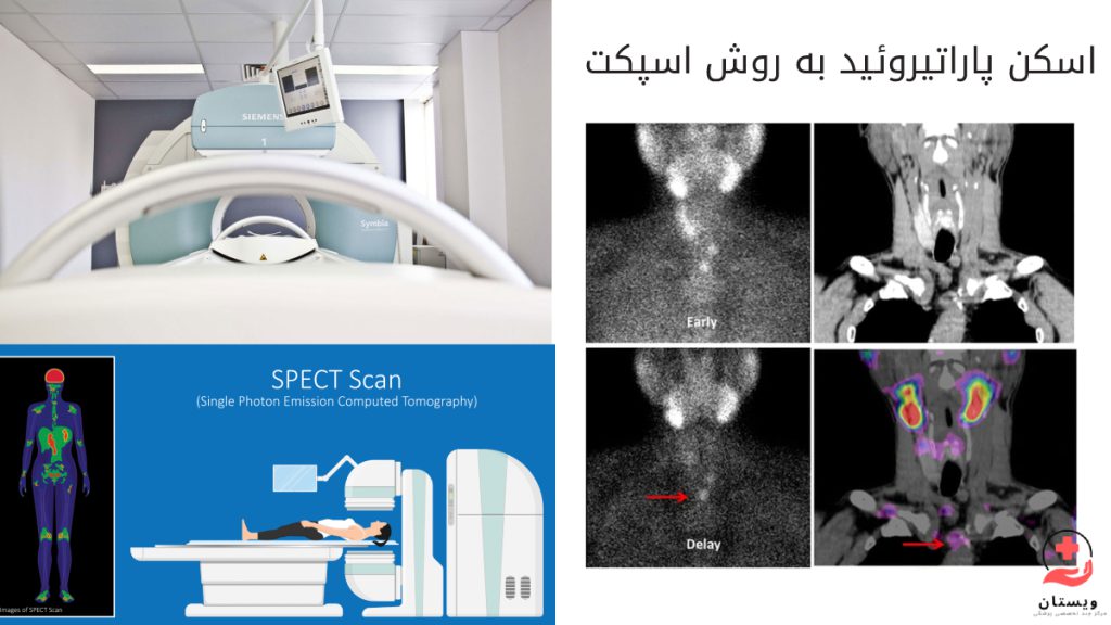 اسکن پاراتیروئید به روش اسپکت چیست؟