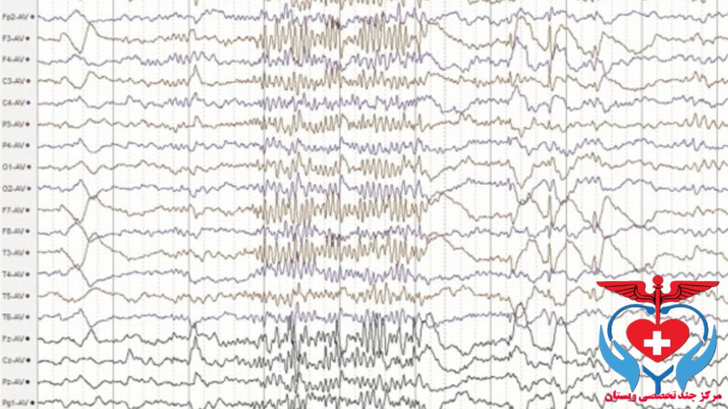 عکس نوار مغز تشنجی عکس نوار مغز تشنجی - تصویری از انفجار ناگهانی فعالیت الکتریکی مغز