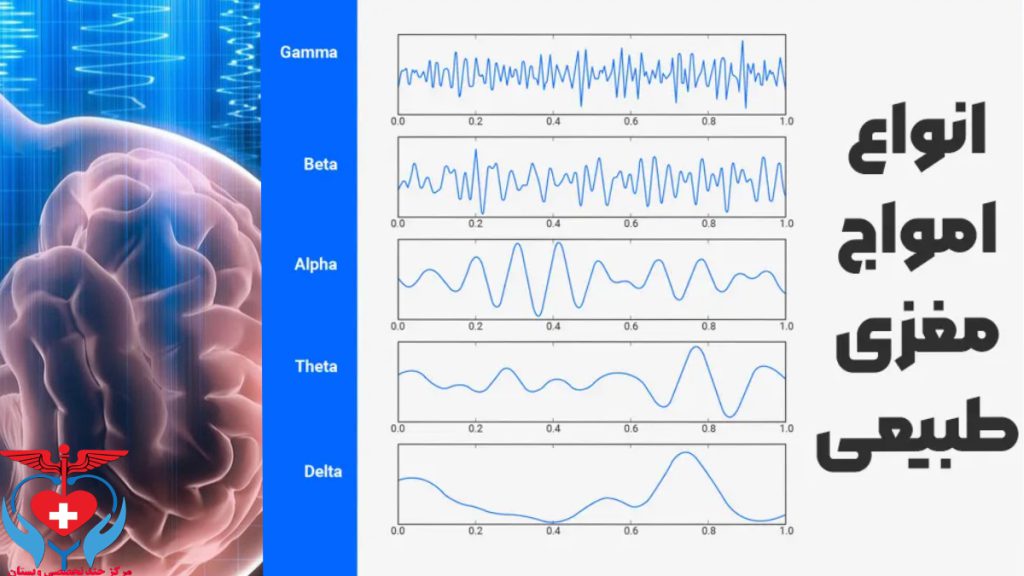 نوار مغز نرمال سالم تصویری از شکل طبیعی امواج مغز امواج آلفا بتا تتا گاما و دلتای مغز در حالت نرمال