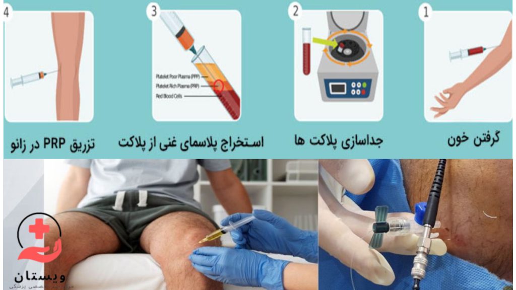 تزریق پی ار پی به زانو عکسی از مراحل تهیه پی ار پی و تزریق به زانو در بهترین مرکز پی ار پی تراپی زانو