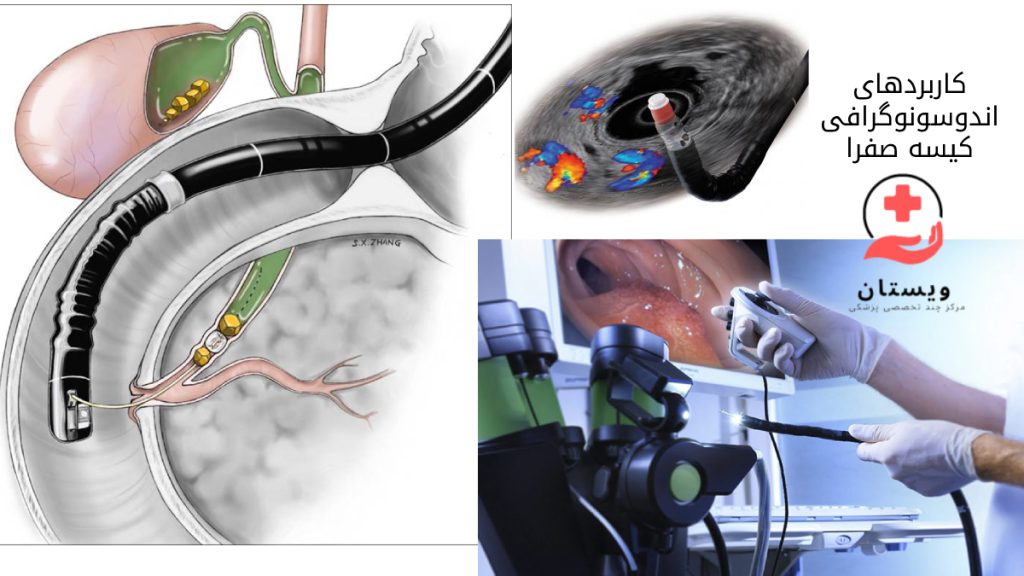 EUS صفرا تصویری از ورود دستگاه اندوسونوگرافی به سیستم گوارش فوقانی و کیسه صفرا