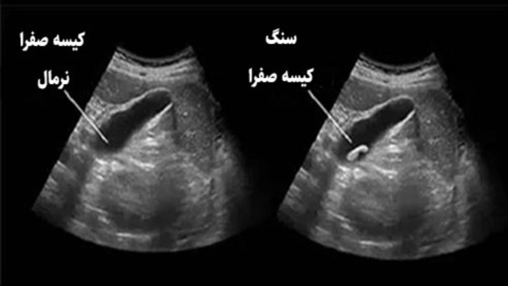 سنگ کیسه صفرا تفسیر جواب اندوسونوگرافی کیسه صفرا - کیسه صفرای نرمال در مقابل سنگ کیسه صفرا