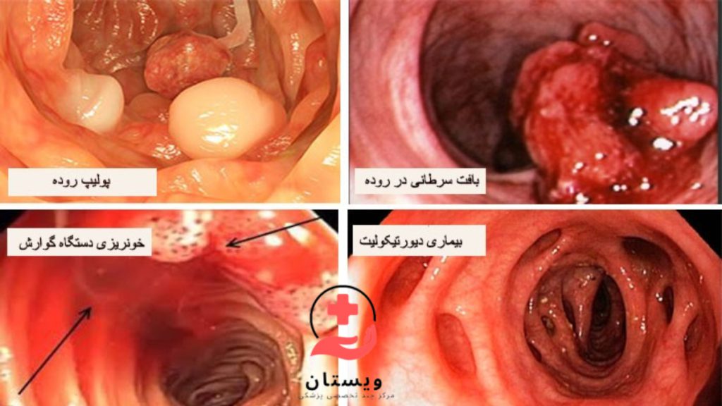 علل کولونوسکوپی در بواسیر تصاویر کولونوسکوپی از مشکلات مختلف روده مثل پولیپ روده ، سرطان روده و خونریزی گوارشی