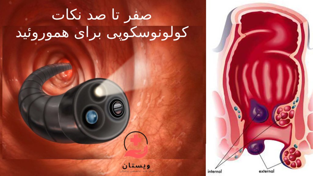 نکات مهم درباره کولونوسکوپی برای بواسیر با هموروئید