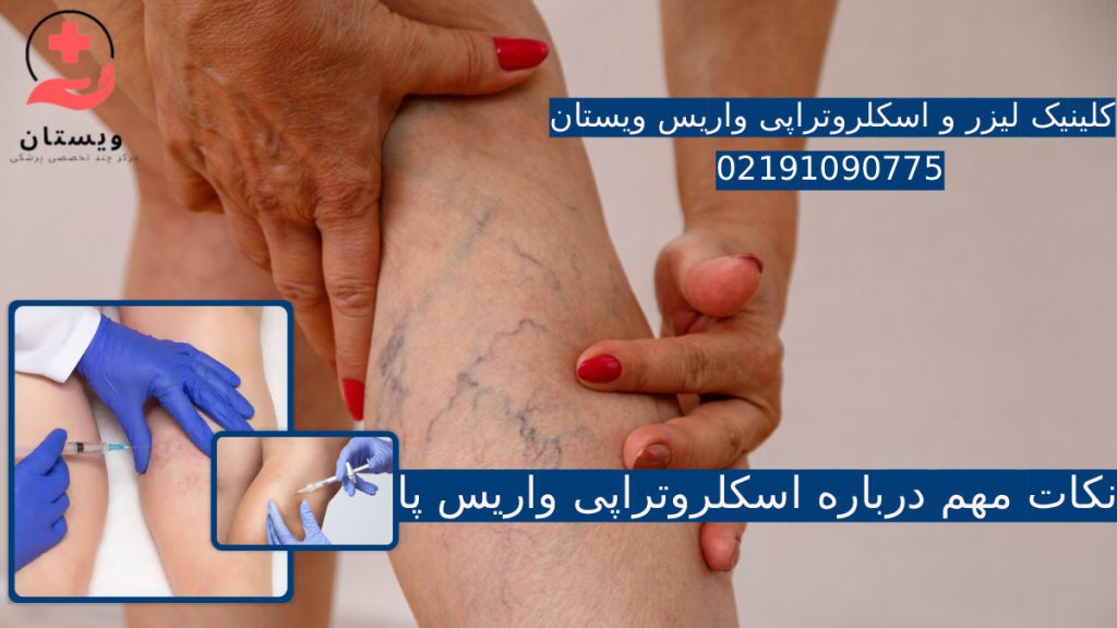 لیزر واریس پا + اسکلروتراپی واریس پا + هزینه ، بهترین مرکز، نکات مهم