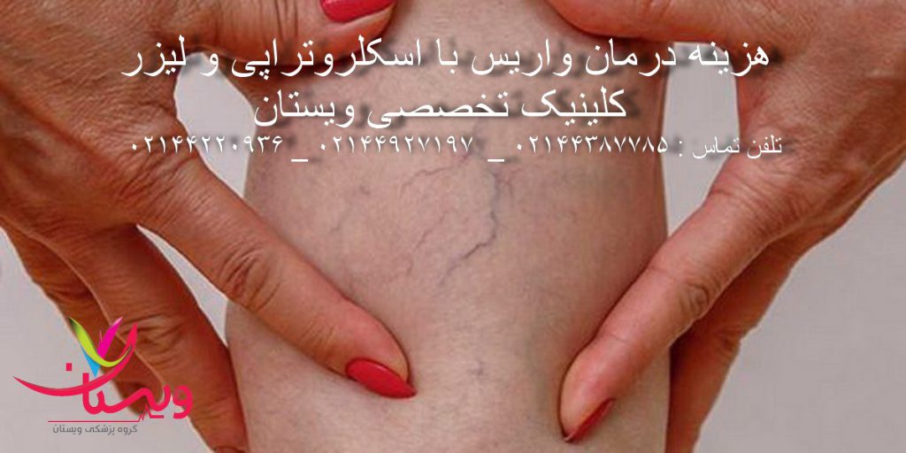 تصویر بیمار مبتلا به واریس های عنکبوتی و پیشرفته روی پا و زیر زانو +شماره بهترین مرکز  درمان واریس 