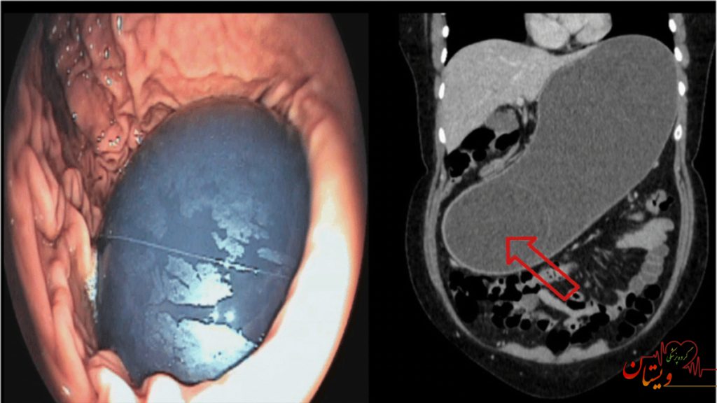 عکس بالن معده عکس واقعی بالون معده که به تصاویر اولترا سوند سونوگرافی ثبت شده است .