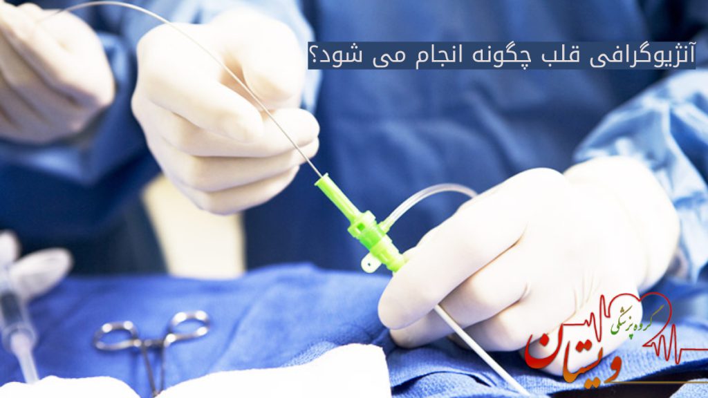 آنژیوگرافی نحوه انجام تصویر یک کاتتر آنژیوگرافی در دست پزشک برای ورود به ورید جهت تزریق ماده حاجب انژیو