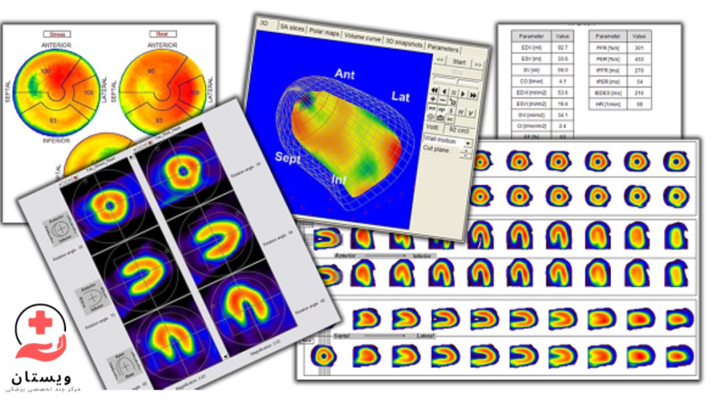 تفسیر عکس رنگی قلب تصاویری مربوط به جواب عکس رنگی قلب و تمامی فاکتورهای مربوط به آن روی برگه و مانیتور