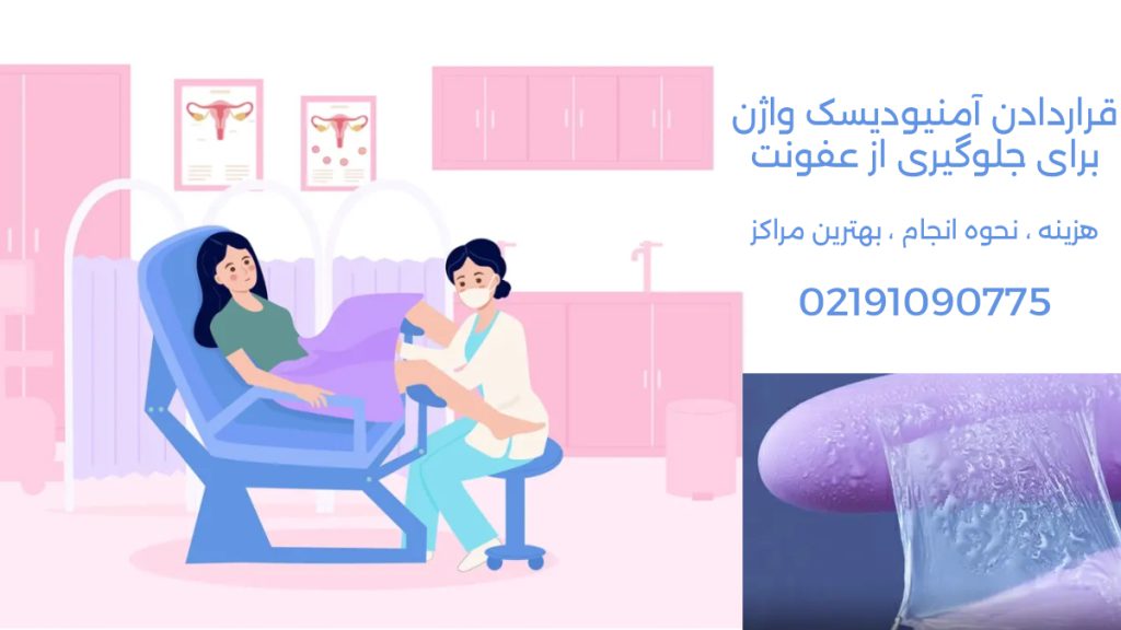 نکات مهم درباره امنیودیسک زخم دهانه رحم | هزینه ها ، بهترین مراکز ، نحوه انجام