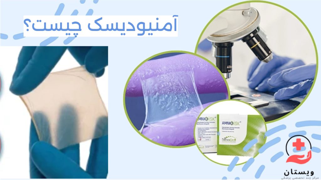 پرده امنیودیسک تصویری از پرده امنیودیسک در دستان پزشک که در زیر میکروسکوپ در حال بررسی و جایگذاری آن است