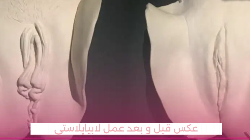 قبل و بعد لابیاپلاستی تصویر شماتیک از ظاهر واژن قبل و بعد از عمل لابیاپلاستی