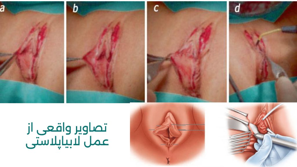 عکس واقعی عمل لابیاپلاستی واژن عکس های واقعی از عمل لابیاپلاستی که حین عمل گرفته شده است