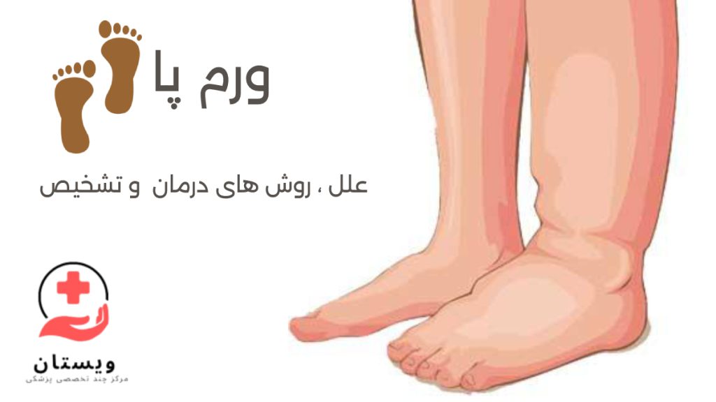 ورم پا چیست؟ شخصی با ورم پای چپ و پای راست عادی در تصویر