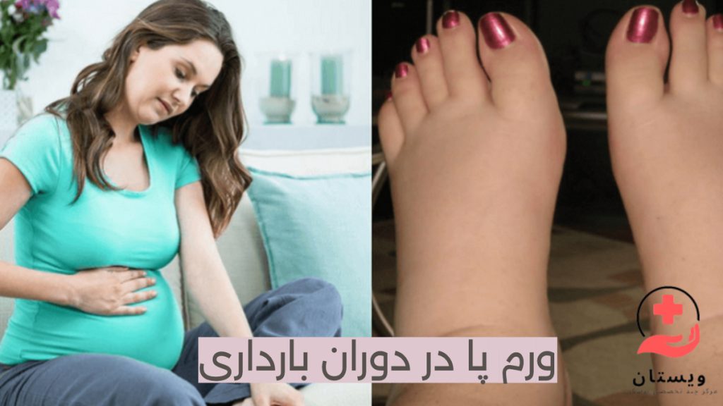 ورم پا و بارداری تصویر یک زن باردار که به پاهای ورم کرده خود بر اثر بارداری نگاه می کند .