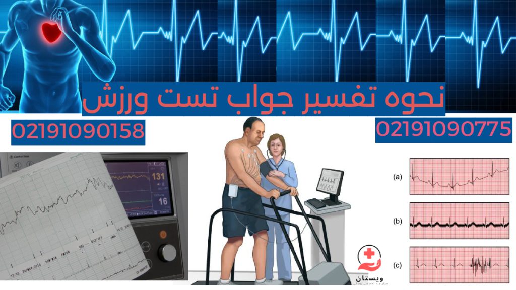 تصاویری مربوط به تست ورزش قلب - تصویر پرینت نوار قلب بعد تست ورزش تصویر شماتیک بیمار در حال انجام تست ورزش تحت نظر متخصص