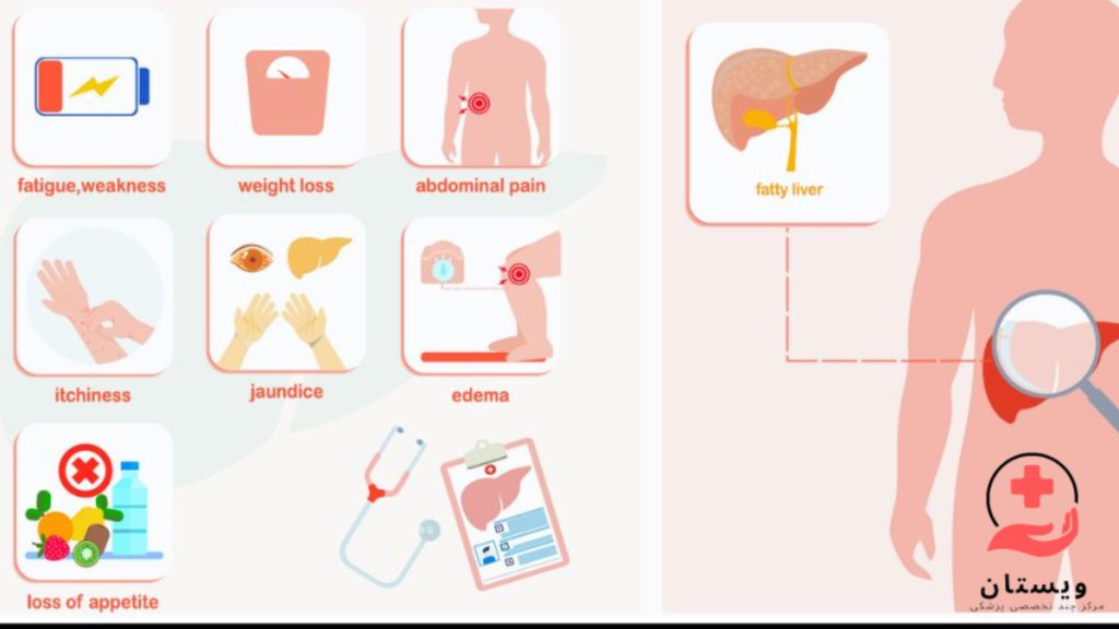 علایم کبد چرب در تصویر مهم ترین علایم کبد چرب به صورت شماتیک نمایش داده شده است .