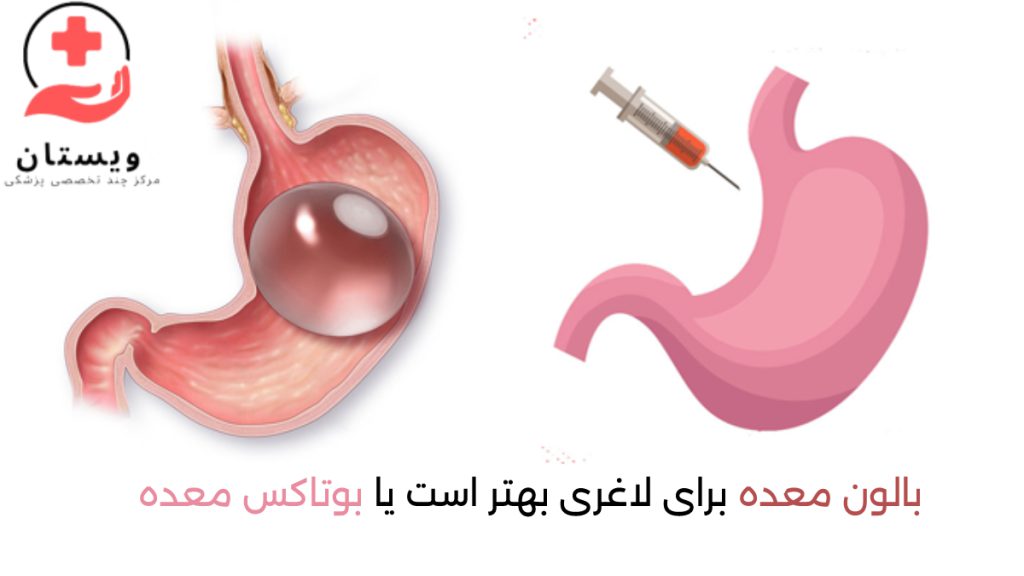 بالون معده و بوتاکس معده تصویر شماتیک از بالون معده و عکس معده به همراه یک آمپول به معنی بوتاکس معده برای لاغری