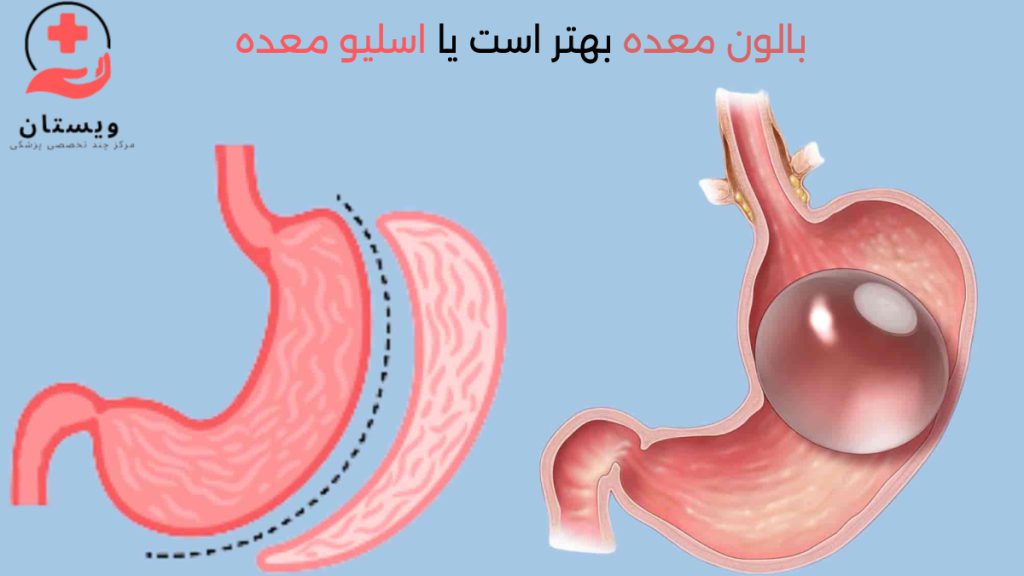 بالون معده بهتره یا اسلیو معده تصویر شماتیک از مقایسه بالون معده و اسلیو معده