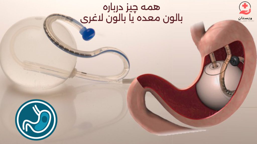 نکات مهم بالون معده - بالن معده چیست