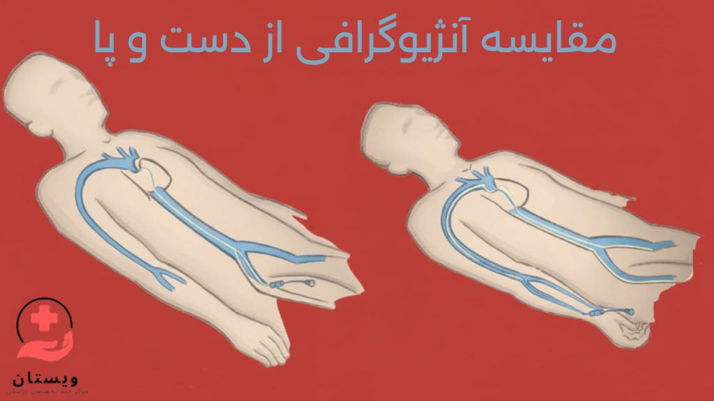 مقایسه آنژیوگرافی از دست و پا