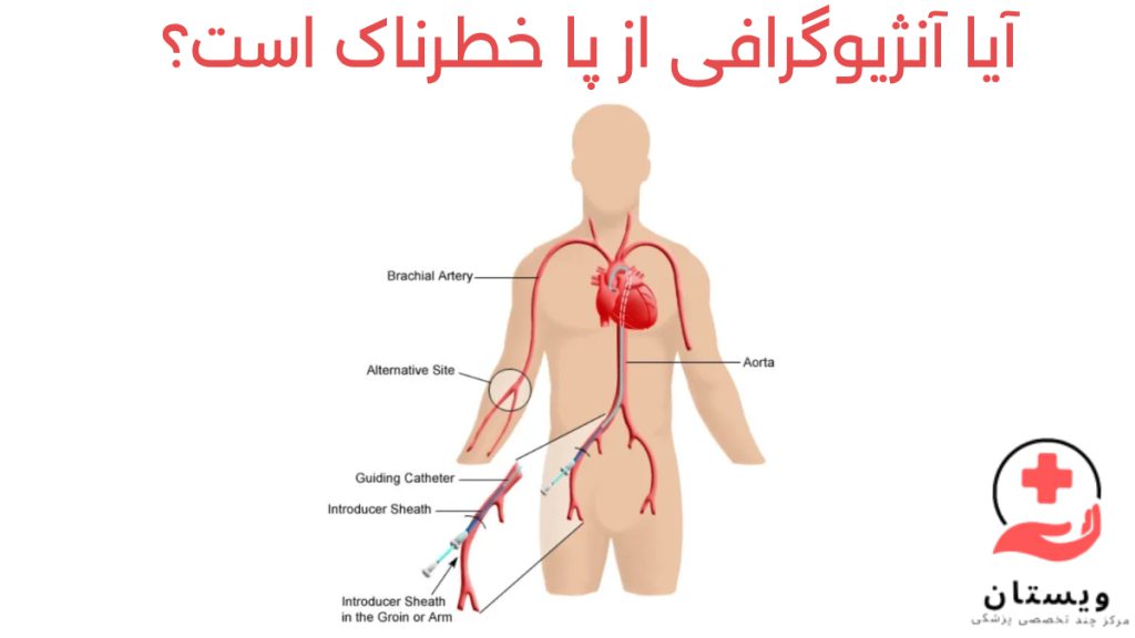 خطرناک آنژیو پا تصویری از تزریق ماده حاجب به رگ پا برای آنژیوگرافی