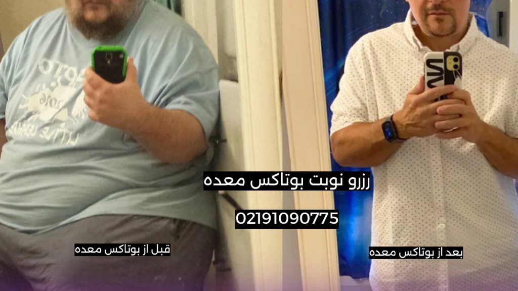 عکس قبل و بعد بوتاکس معده تصویر واقعی یک فرد قبل و بعد از بوتاکس معده با اصلاح تغذیه و میزان وزن کم کردن