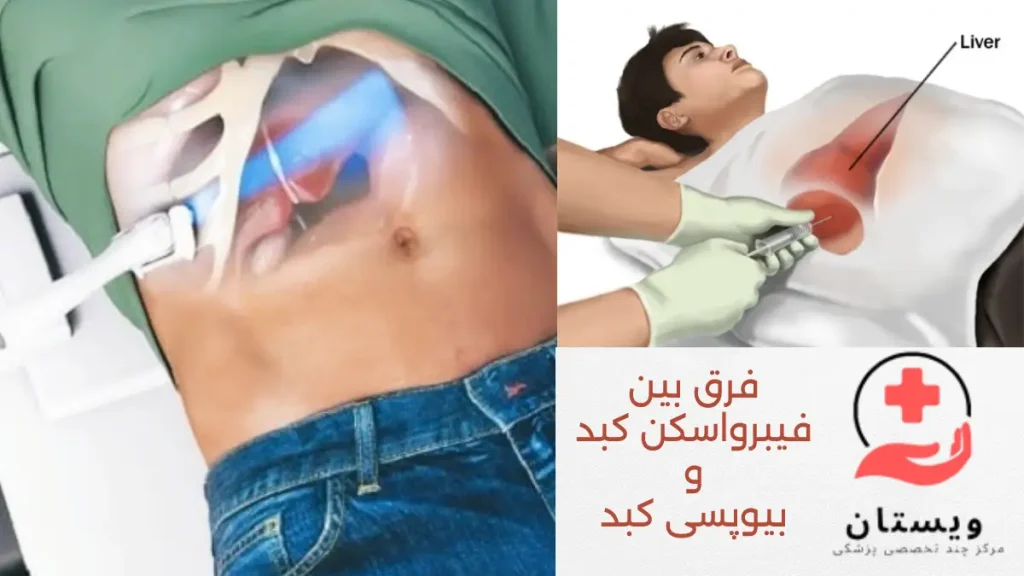 مقایسه فیبرواسکن کبد با بیوپسی کبد تصویری از مقایسه فیبرواسکن کبد در مقابل بیوپسی کبد