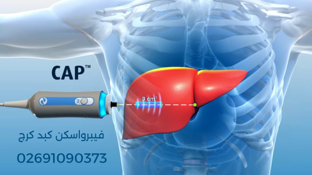 کپ در فیبرواسکن کبد تصویری از دستگاه فیبرواسکن کبد و تصویر کبد که نشان می دهد 3 سانتی متر مکعب را اندازه گیری می کند