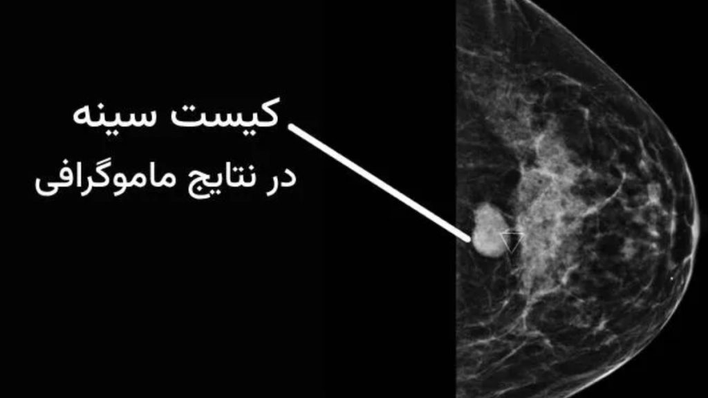 کیست پستان کیست سینه در جواب ماموگرافی