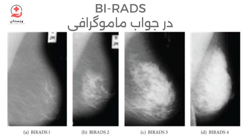 BI-RADS در تصویر نمرات BI-RADS یک تا چهار در ماموگرافی واقعی نمایش داده شده است