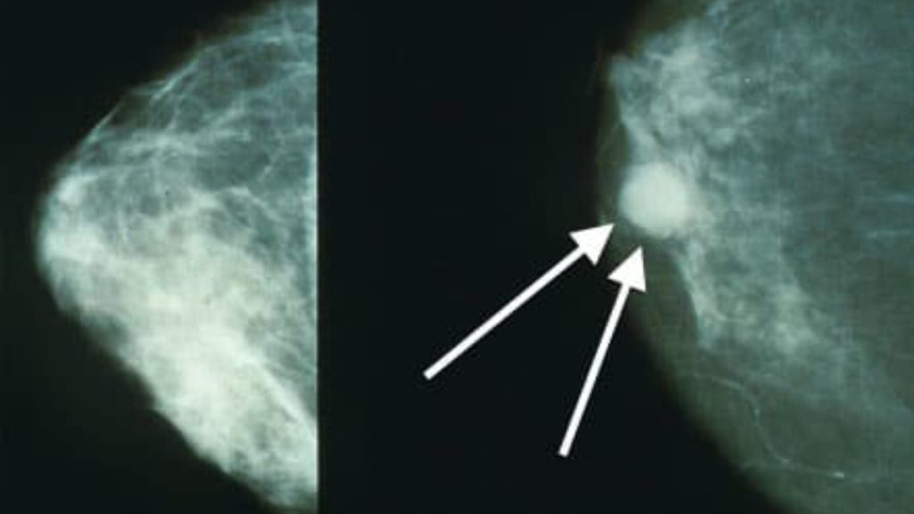 ماموگرافی سرطان عکس توده سرطانی در جواب ماموگرافی