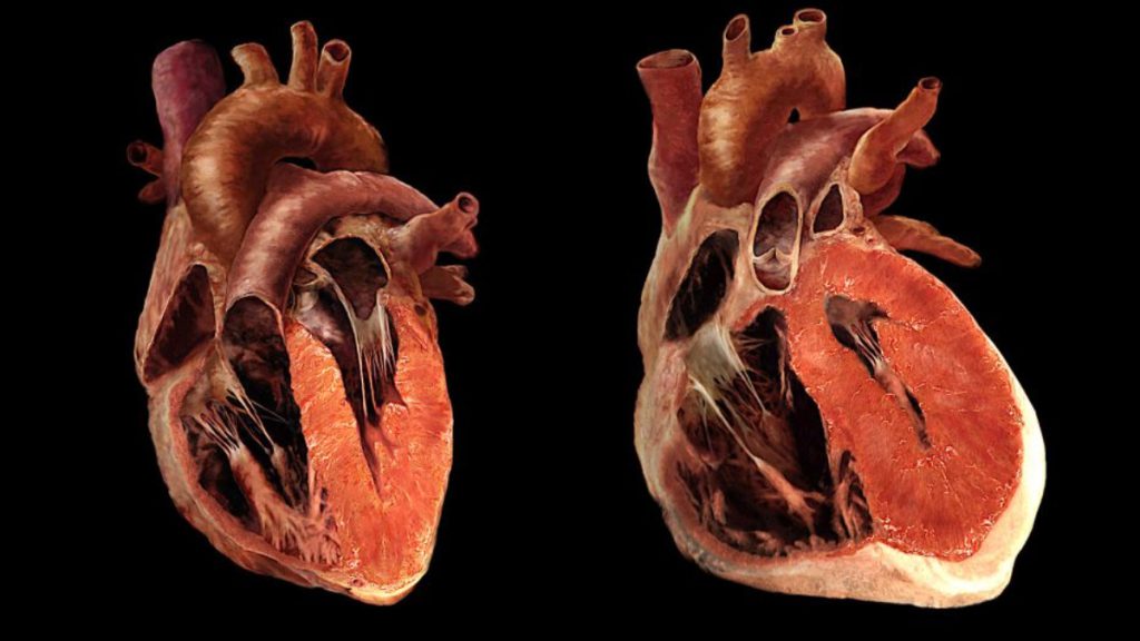 بزرگ شدن قلب مقایسه عکس قلب نرمال و قلبی که بزرگ شده است