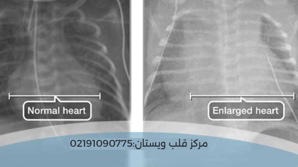 کاردیومگالی قلب نرمال در مقابل کاردیومگالی چگونه است در اکو
