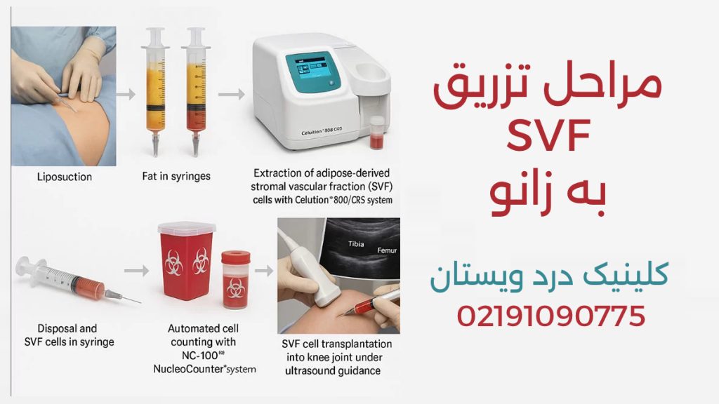 اس وی اف ژل در این تصویر مراحل تزریق اس وی اف به زانو نشان داده شده است.