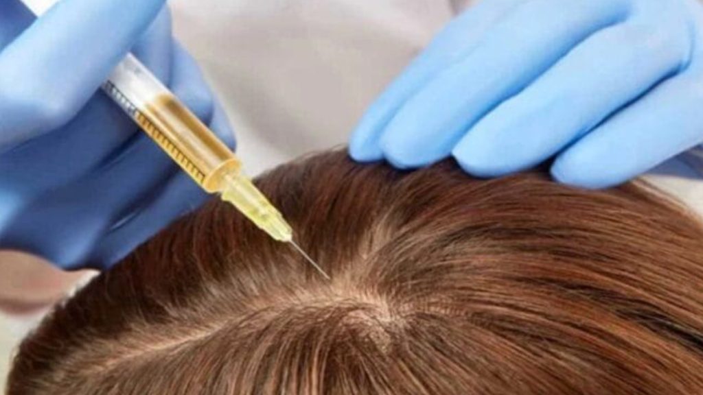 اس وی اف مو نحوه تزریق اس وی اف به مو سرنگ در دست پزشک و در حال تزریق به کف سر بیمار