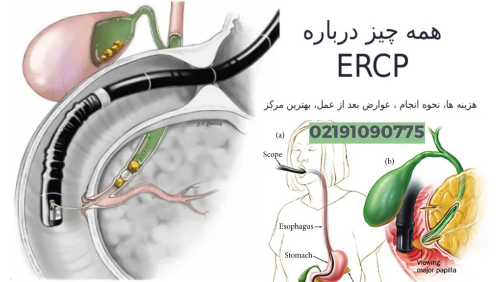 هزینه ercp در بیمارستان دولتی و خصوصی چقدر است؟