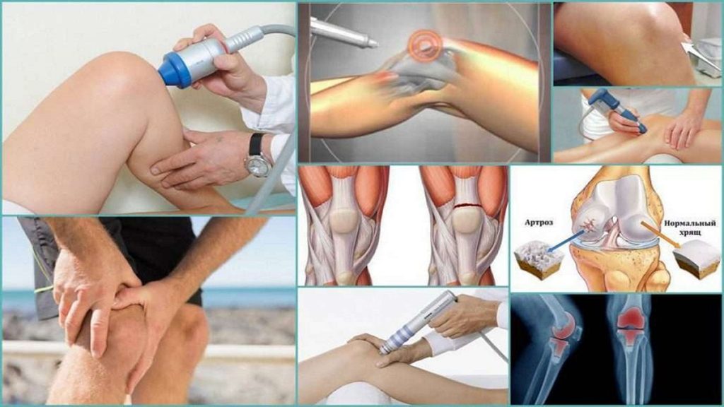 تزریق ژل به زانو تصاویری مربوط به درمان غیرجراحی زانو درد 