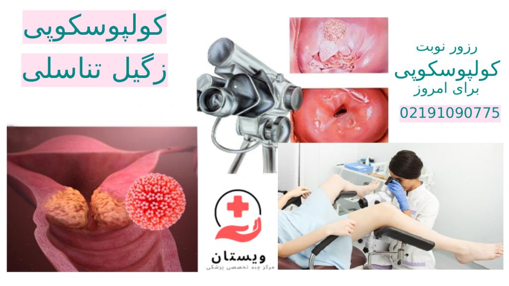کولپوسکوپی رحم در تهران کولپوسکوپی زگیل تناسلی در تهران شماره تماس بهترین مرکز کولپوسکوپی رحم در تهران