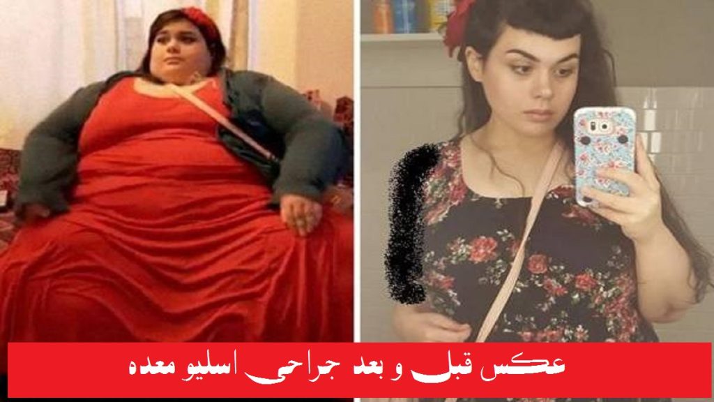 دختری که با bmi بالای 40 اسلیو معده انجام داده و حالا 90 کلیو وزن کم کرده است. نظرات کسانی که عمل اسلیو انجام دادند